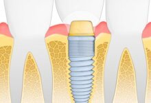 shutterstock_70163050 dental implants